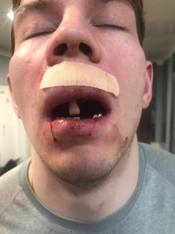 Форвард СКА Зыков потерял почти все передние зубы и получил перелом лицевой кости после силового приема Радулова. Фото1
